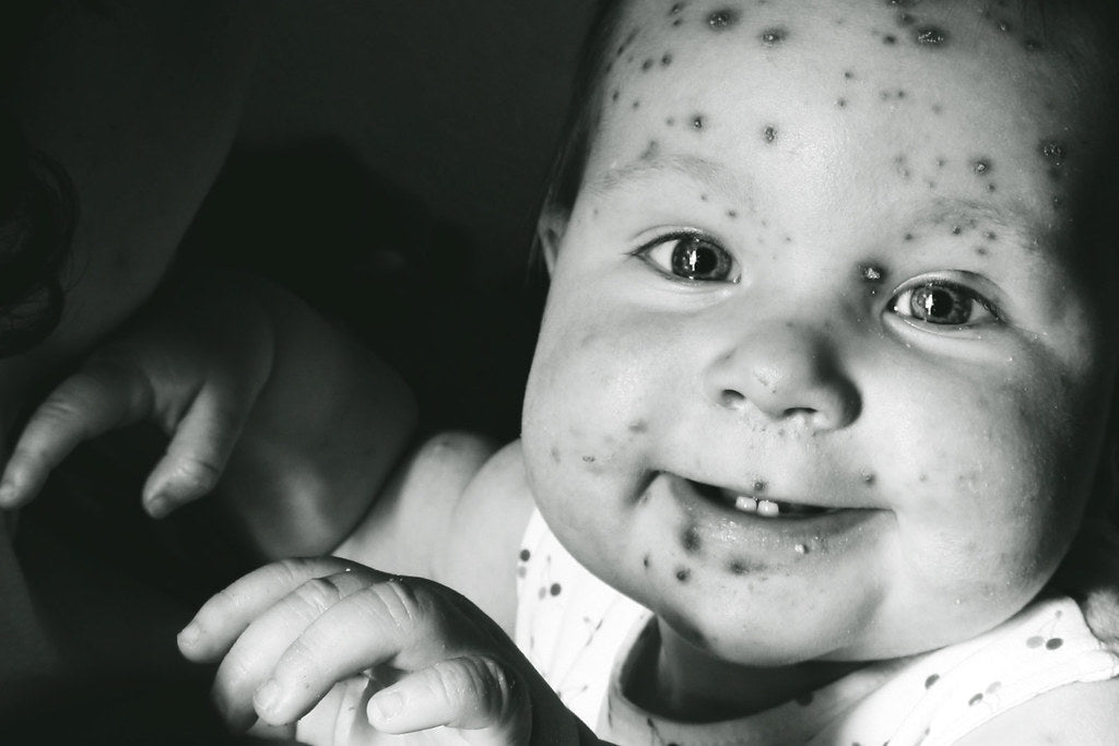 Is chickenpox dangerous during pregnancy?